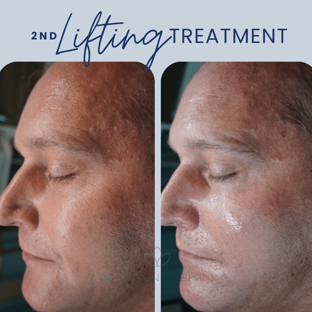L-IFT System at Botanic Skin Spa in Lewisville, TX